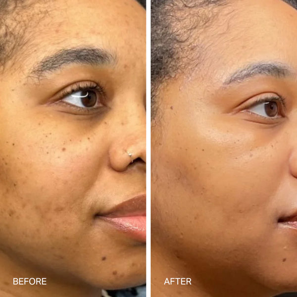 The Laser Serum Triple Acid Concentrate