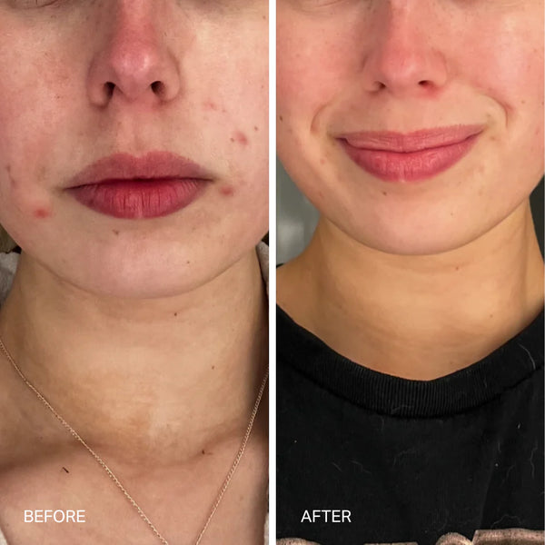 The Laser Serum Triple Acid Concentrate
